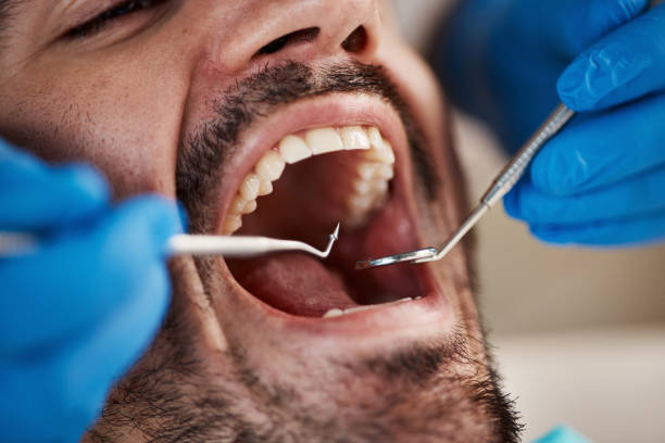 Best Emergency Wisdom Teeth Removal in Fircrest, WA